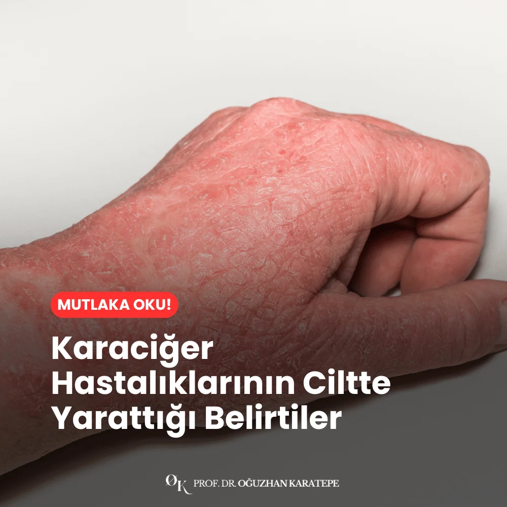 Karaciğer Hastalıklarının Ciltte Yarattığı Belirtiler nelerdir
