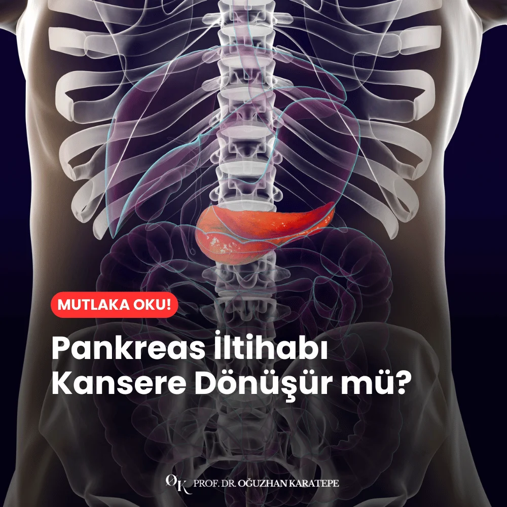 Pankreas İltihabı Kansere Dönüşür mü?
