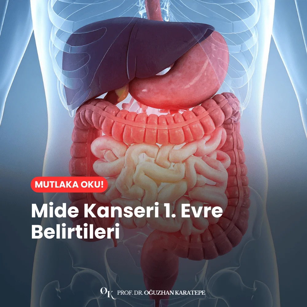 Mide Kanseri 1. Evre Belirtileri Nedir