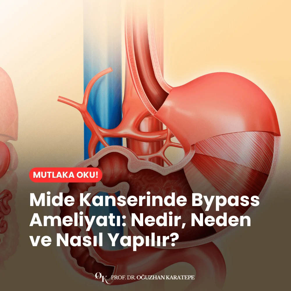 Mide Kanserinde Bypass Ameliyatı Nedir, Neden ve Nasıl Yapılır?