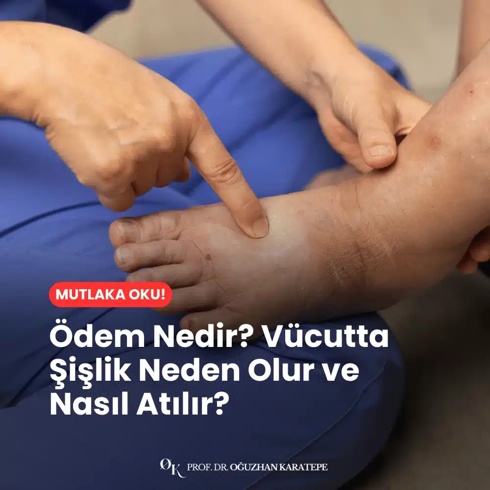 Ödem Nedir? Vücutta Şişlik Neden Olur ve Nasıl Atılır