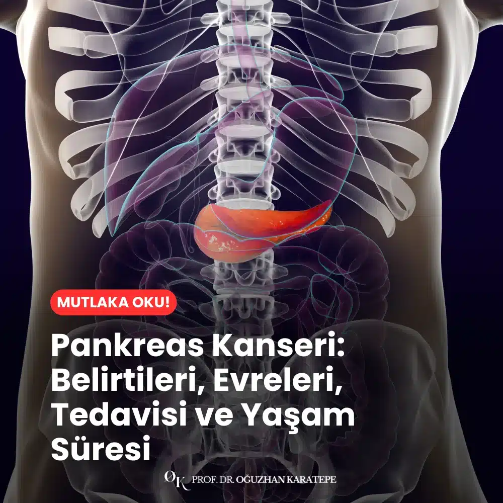 Pankreas Kanseri Belirtileri, Evreleri, Tedavisi ve Yaşam Süresi