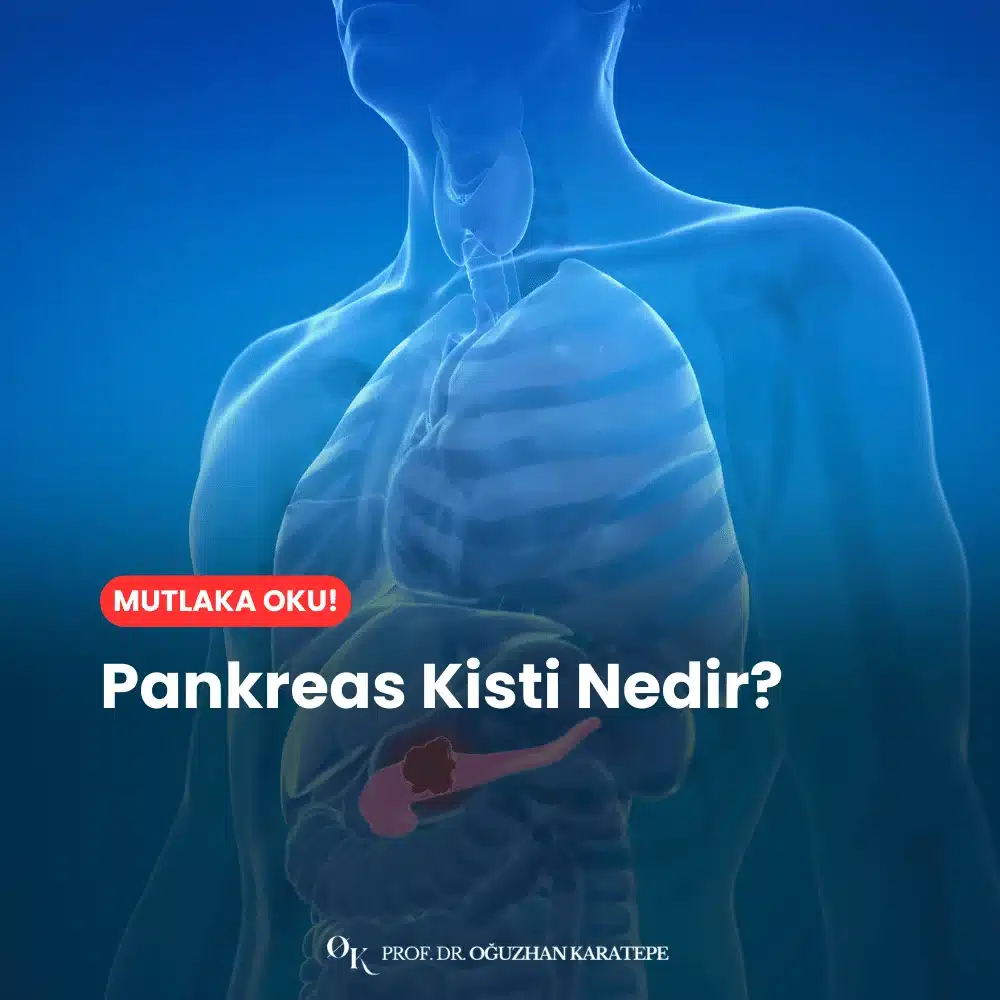 Pankreas Kisti Nedir?