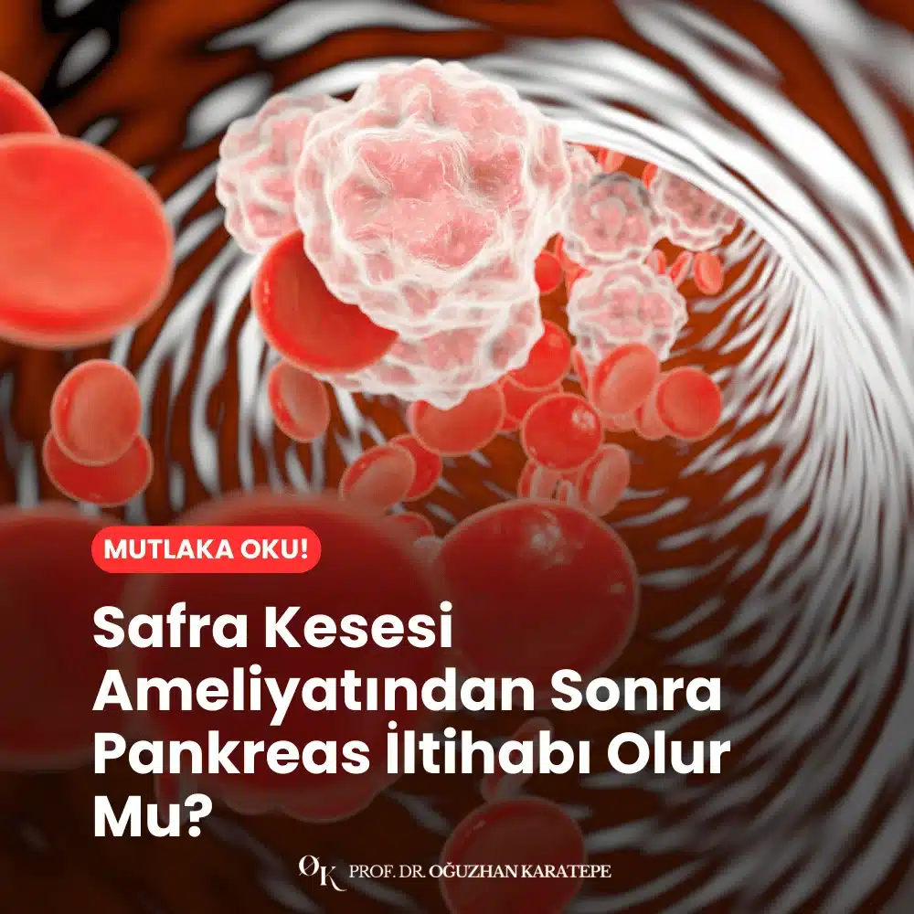 Safra Kesesi Ameliyatından Sonra Pankreas İltihabı Olur Mu