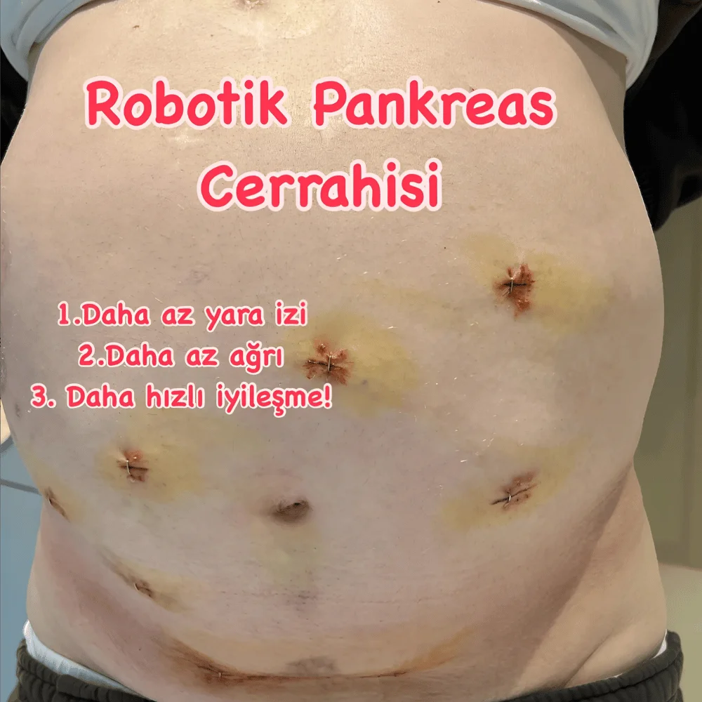 robotik cerrahi yara izi görüntüsü