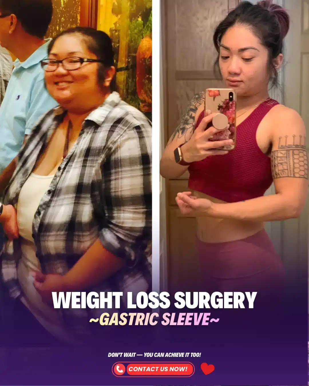 Best Bariatric Surgeon Turkey