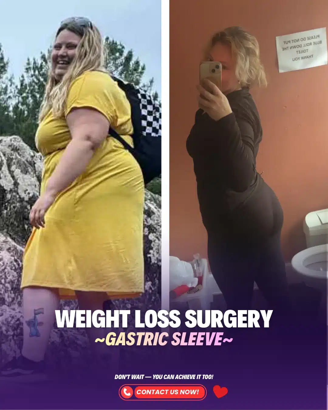 Best Bariatric Surgery Turkey