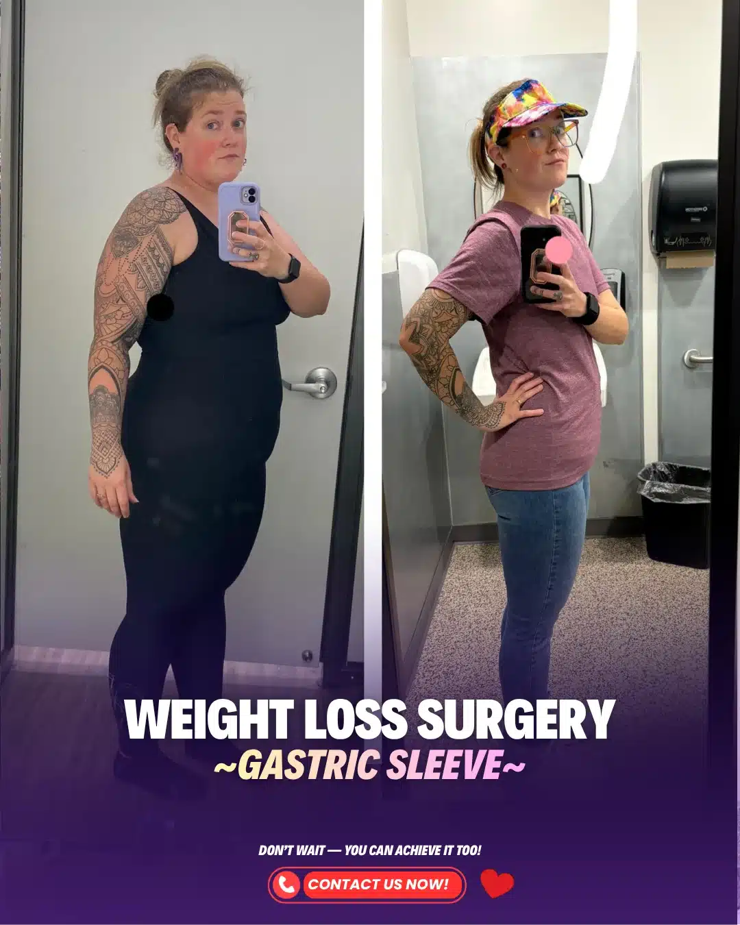 Before After Gastric Sleeve Surgery