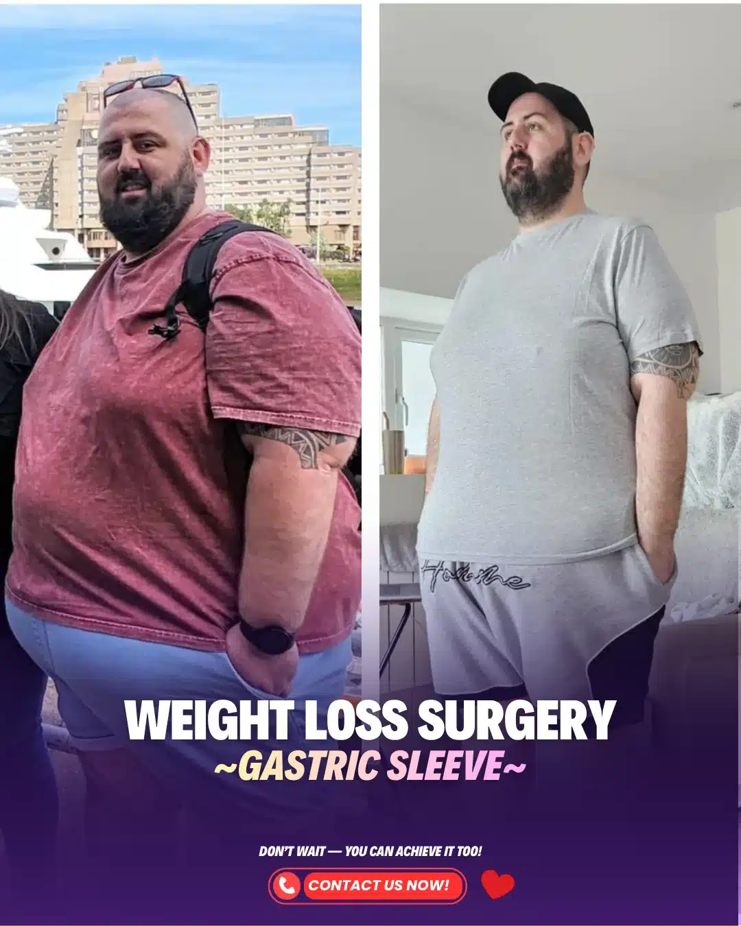 Before After Men Gastric Sleeve
