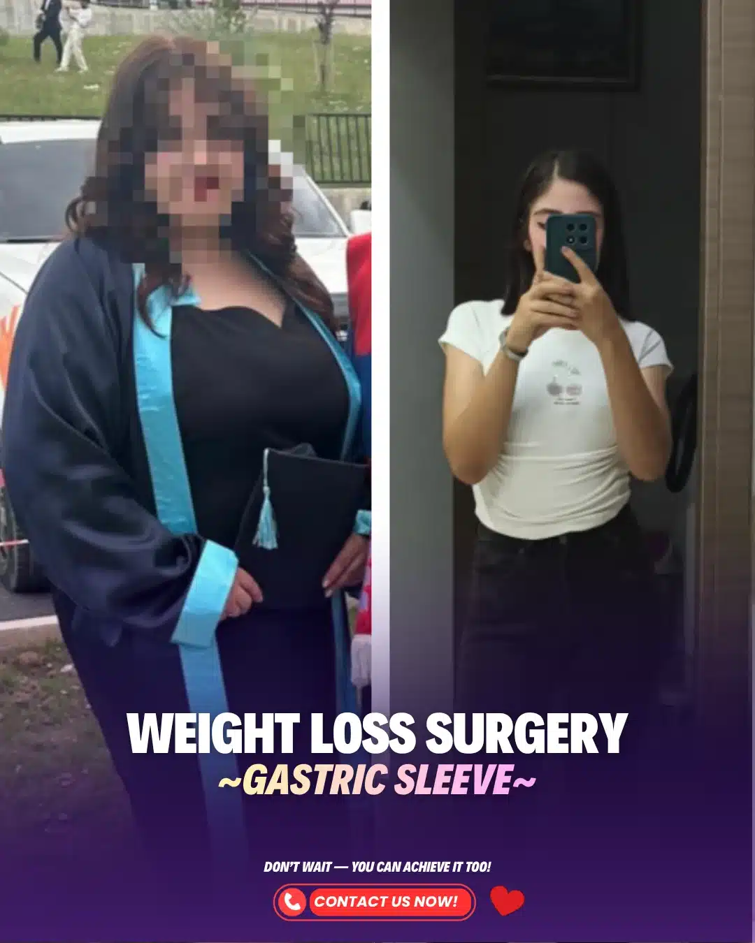 Best Weight Loss Surgery Turkey