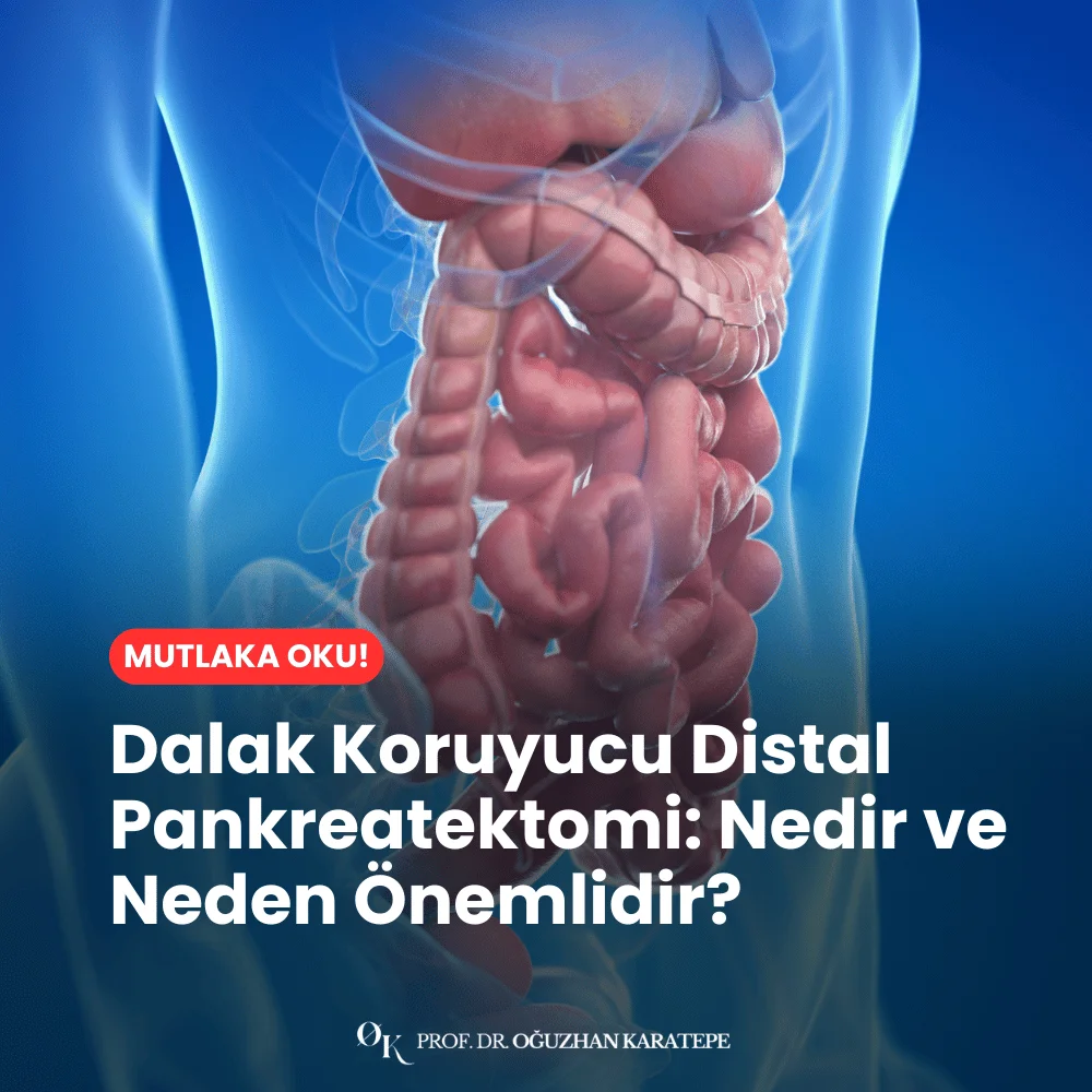 Dalak Koruyucu Distal Pankreatektomi Nedir ve Neden Önemlidir