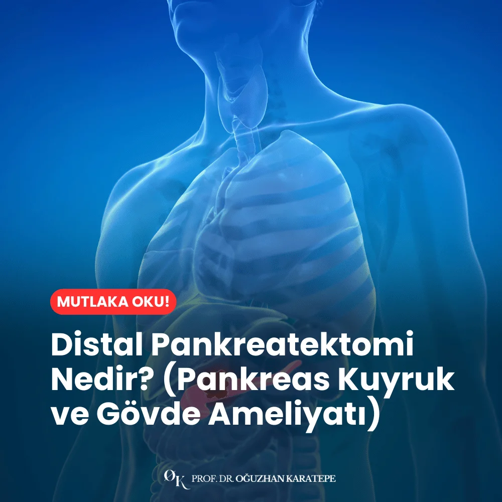 Distal Pankreatektomi Nedir? (Pankreas Kuyruk ve Gövde Ameliyatı) Nedir
