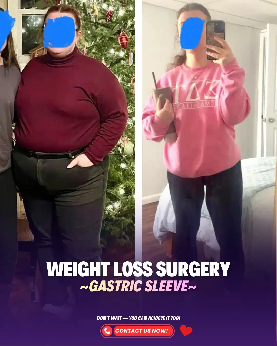 Gastric Sleeve Before After Result