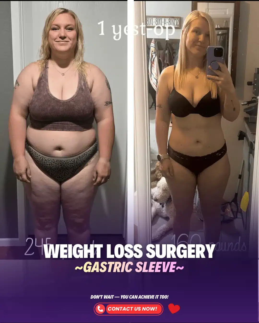 Best Bariatric Surgeon Turkey