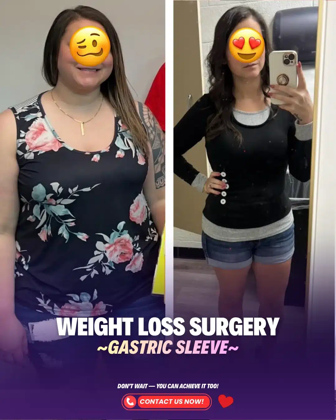 Bariatric Surgery Turkey Before After