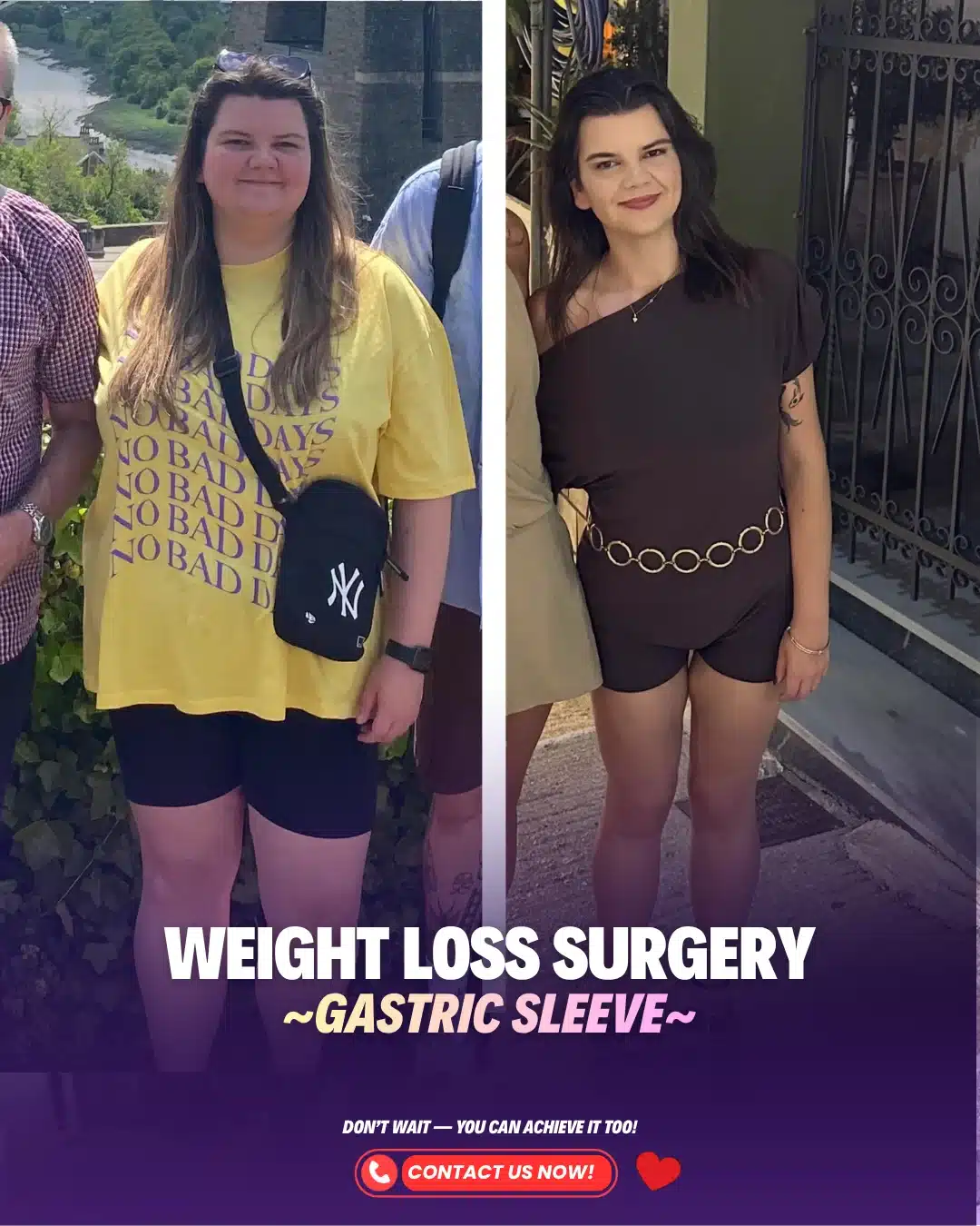 Gastric Sleeve Surgeon Turkey Before After