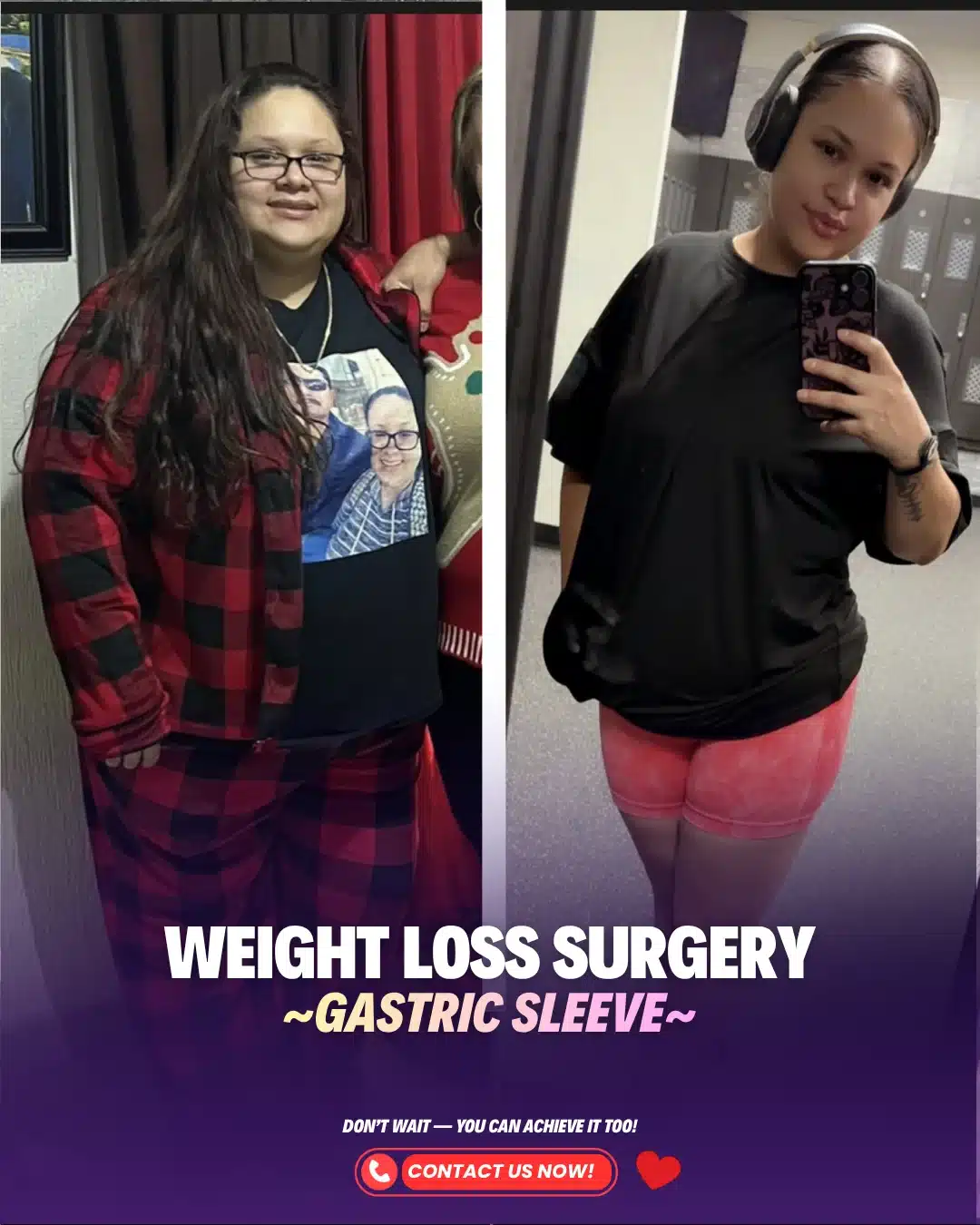 Bariatric Surgery Turkey Before After