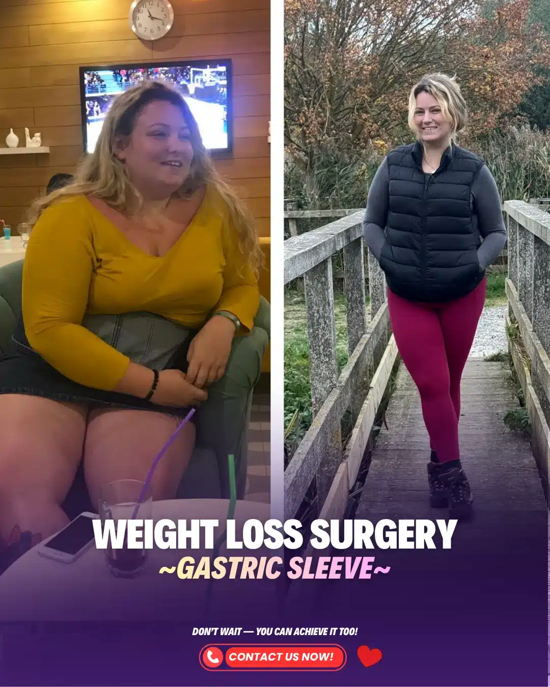 Bariatric Surgery Turkey Before After