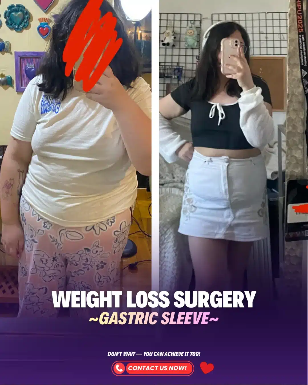 Best Bariatric Surgery Turkey