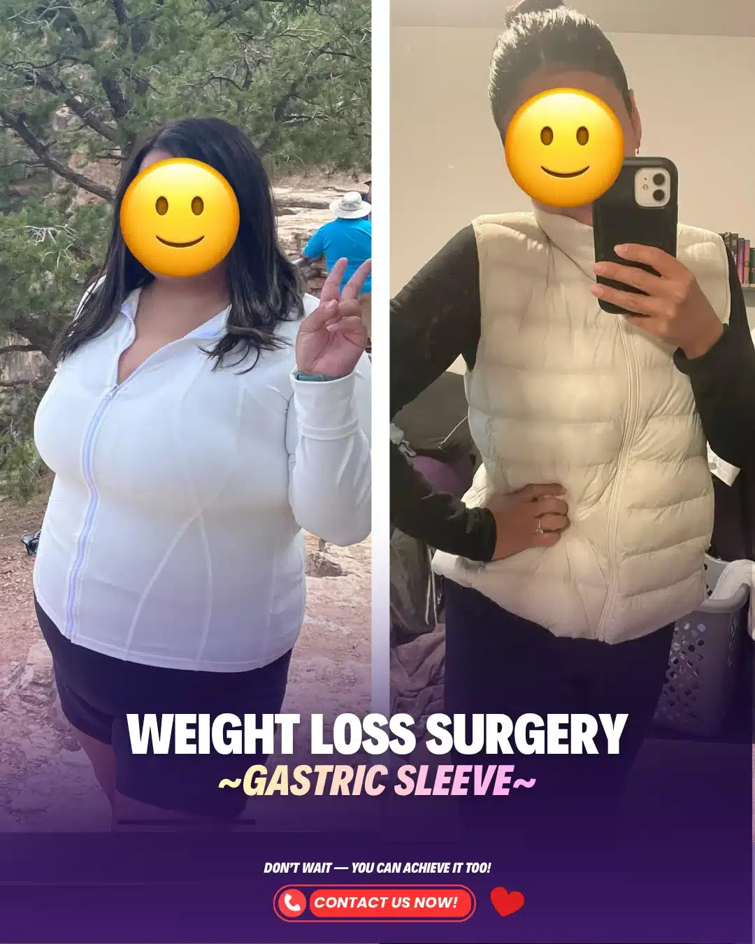 Bariatric Surgery Turkey Before After