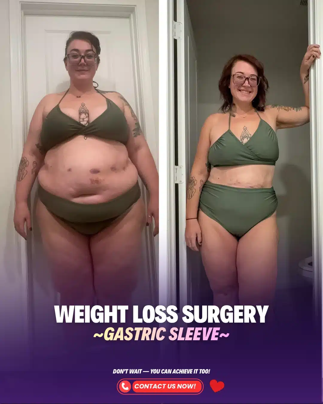 Best Bariatric Surgery Turkey