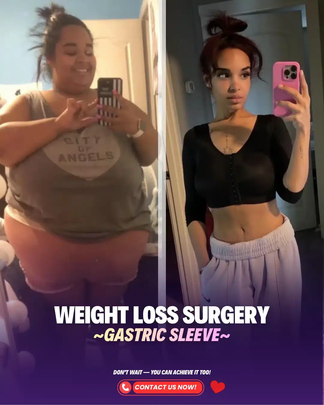 Bariatric Surgery Turkey Before After