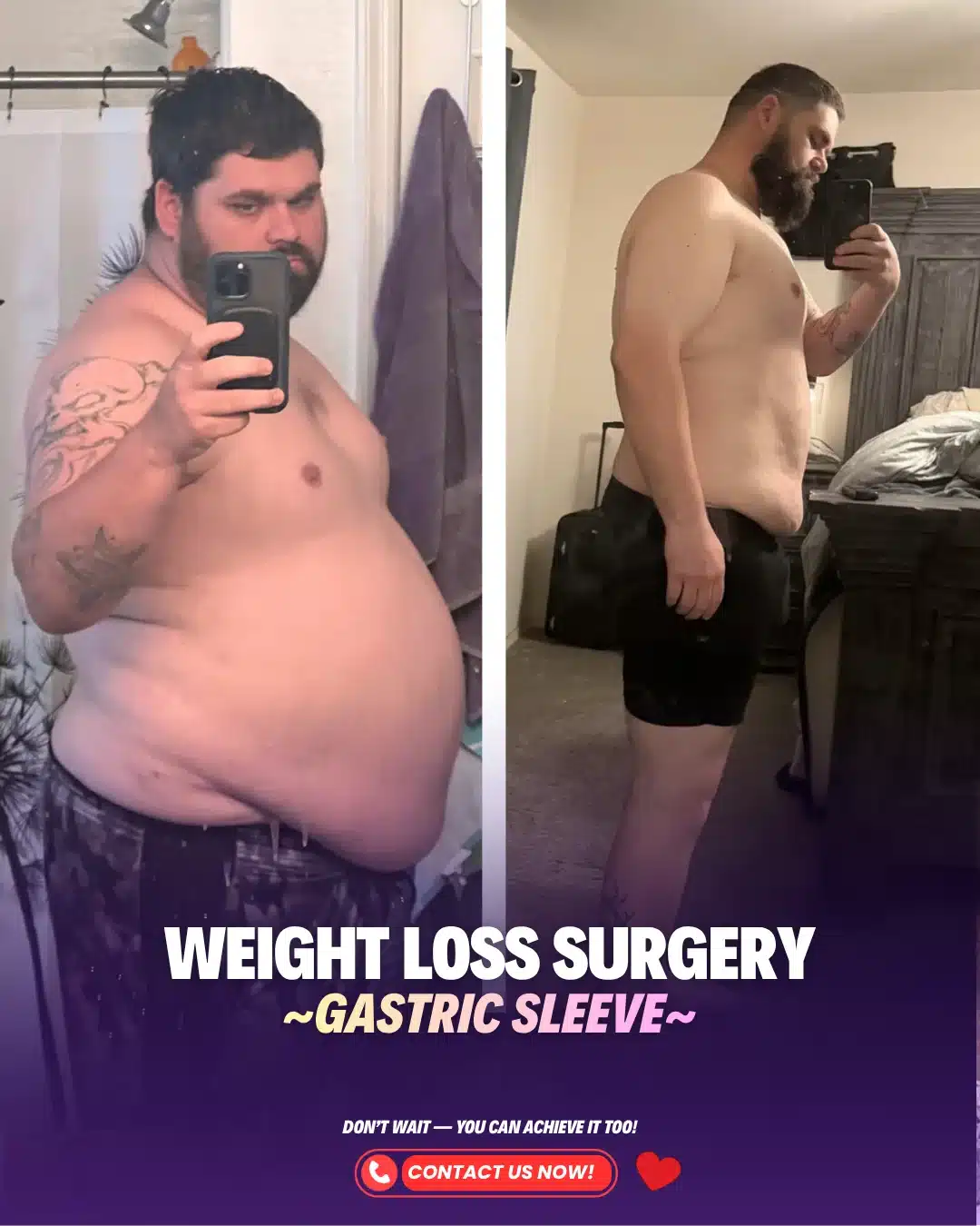 Bariatric Surgery Turkey Before After