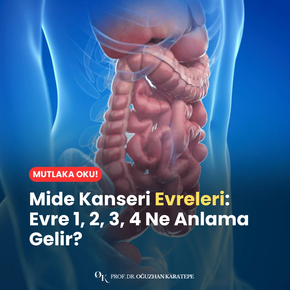 Mide Kanseri Evreleri Evre 1, 2, 3, 4 Ne Anlama Gelir?
