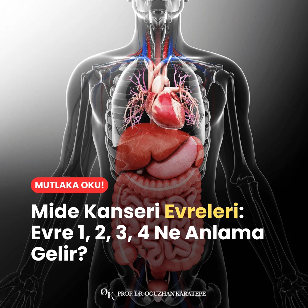 Mide Kanseri Evreleri Evre 1, 2, 3, 4 Ne Anlama Gelir