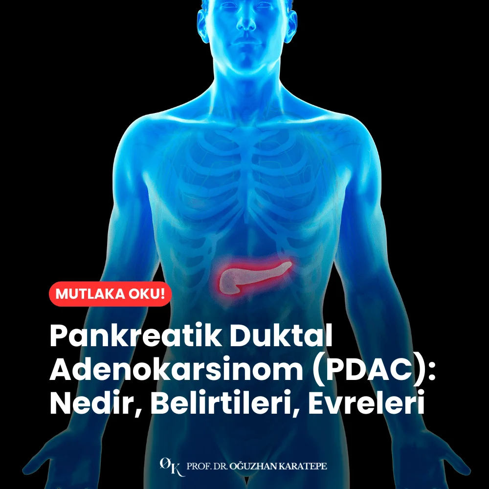 Pankreatik Duktal Adenokarsinom (PDAC) Nedir, Belirtileri, Evreleri ve Modern Tedavi Yöntemleri