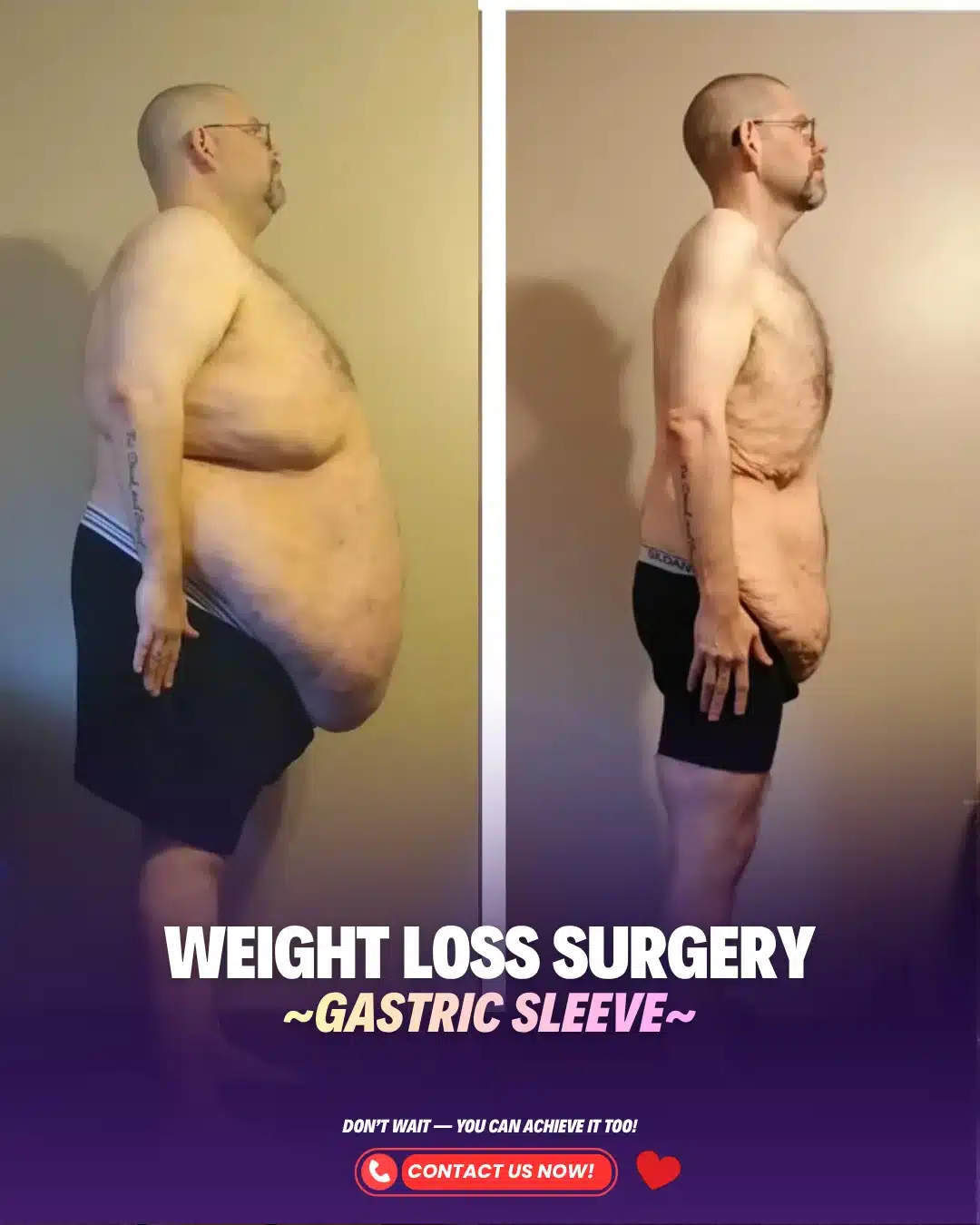 Best Bariatric Surgery Turkey