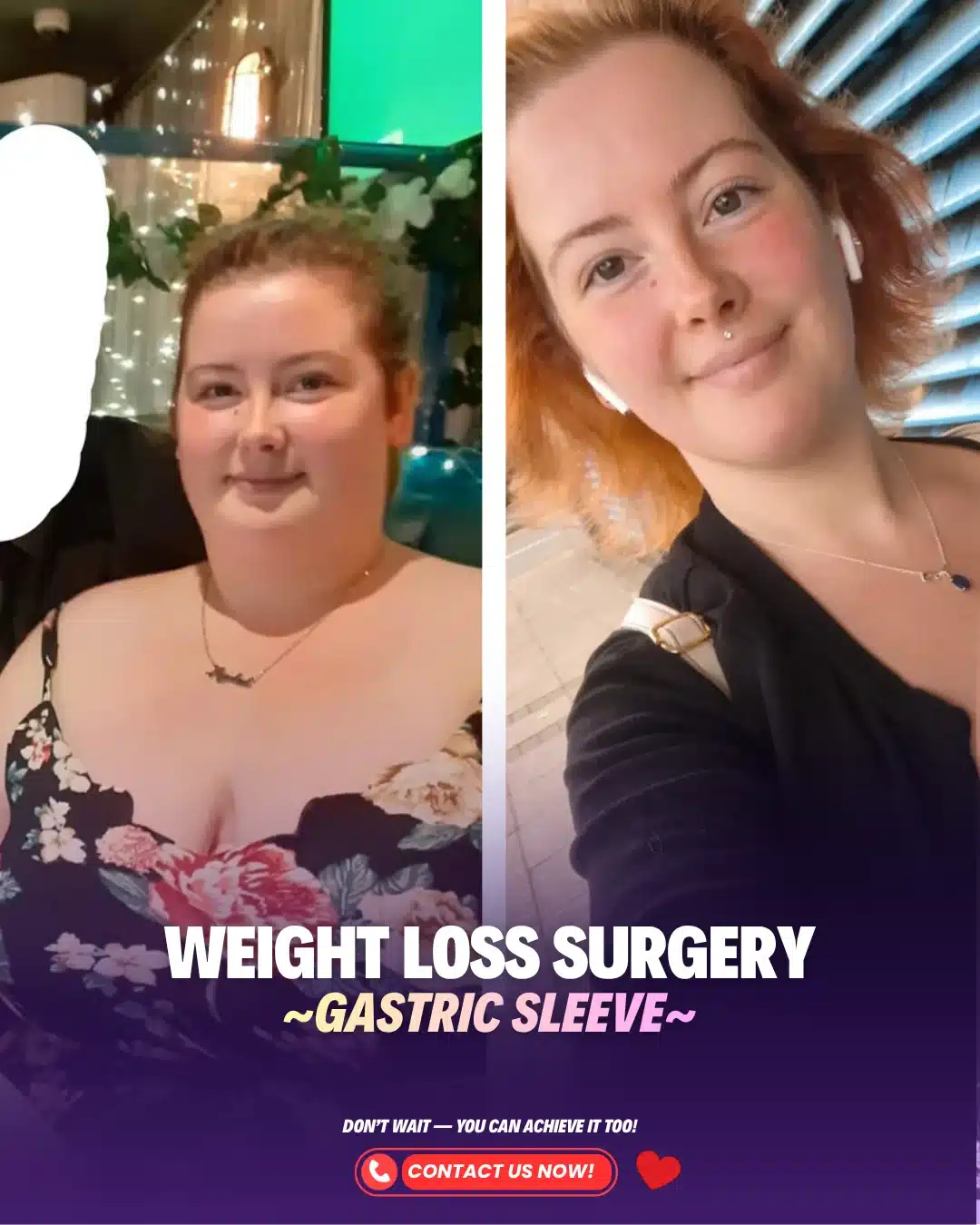 Turkey Gastric Sleeve