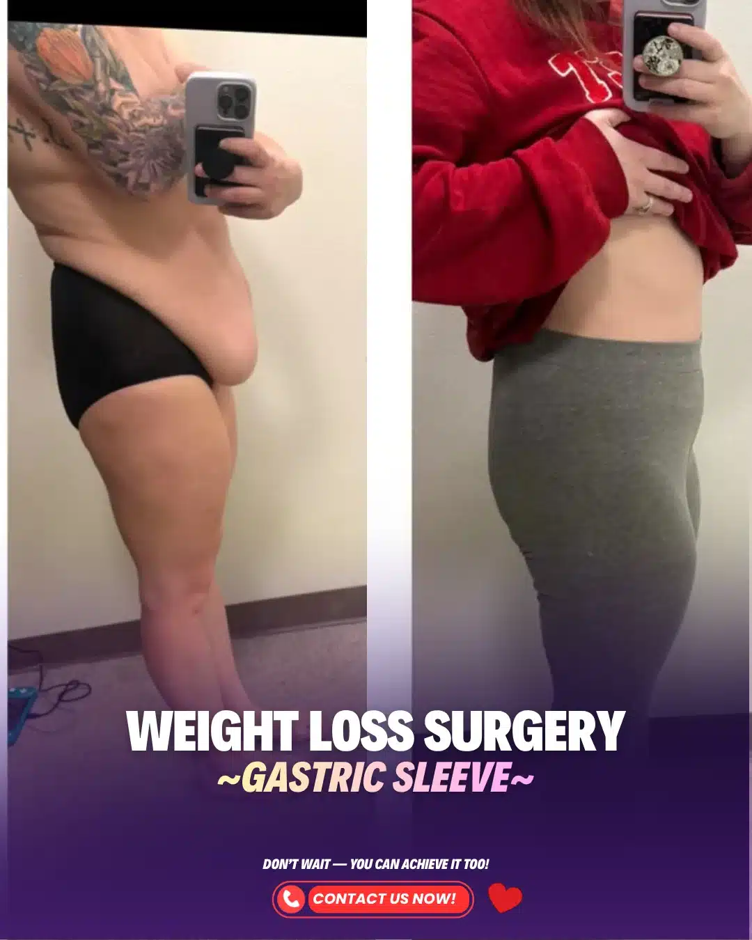 Turkey Weight Loss Bariatric Gastric Sleeve