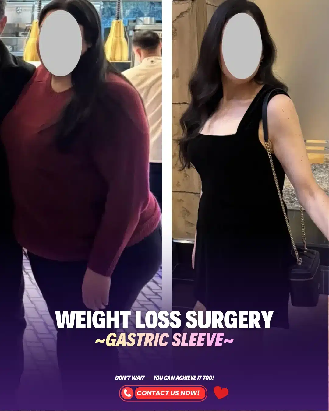 Bariatric Surgery Turkey Before After