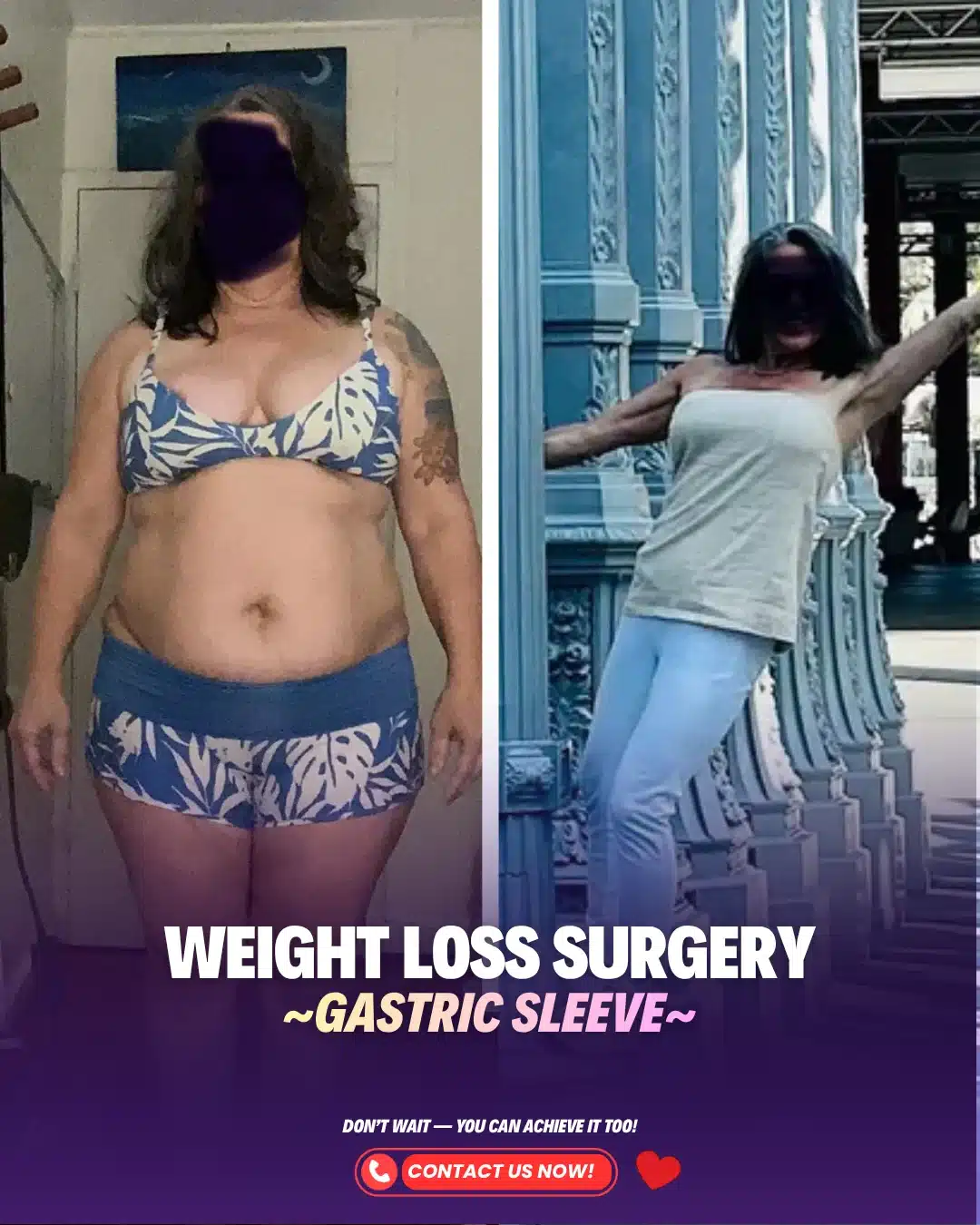 Best Bariatric Surgery Turkey