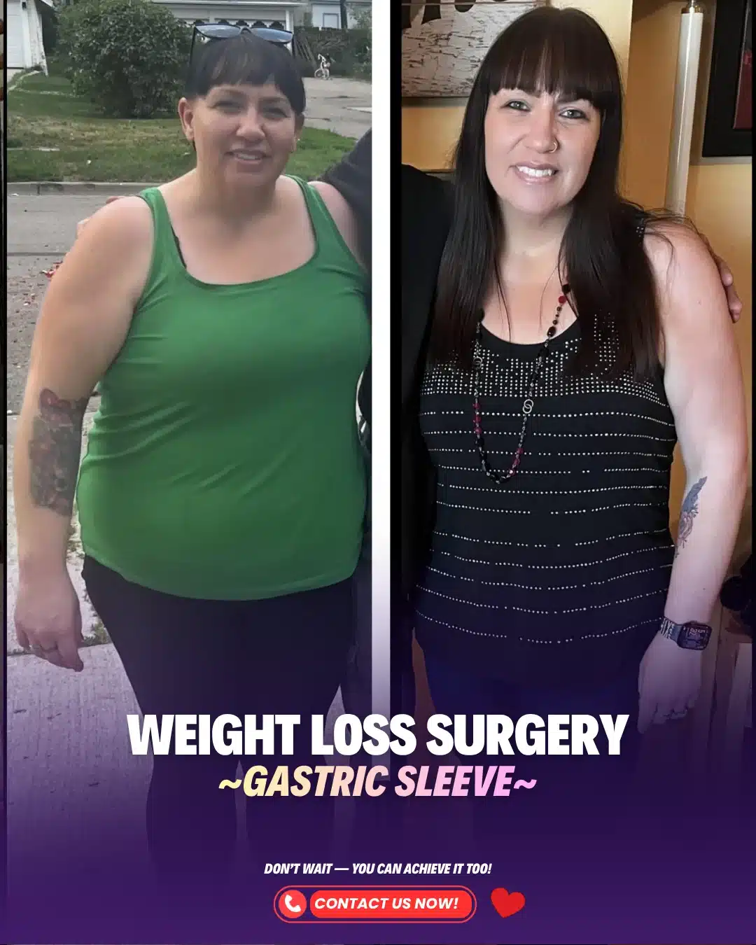 Bariatric Surgery Turkey Before After