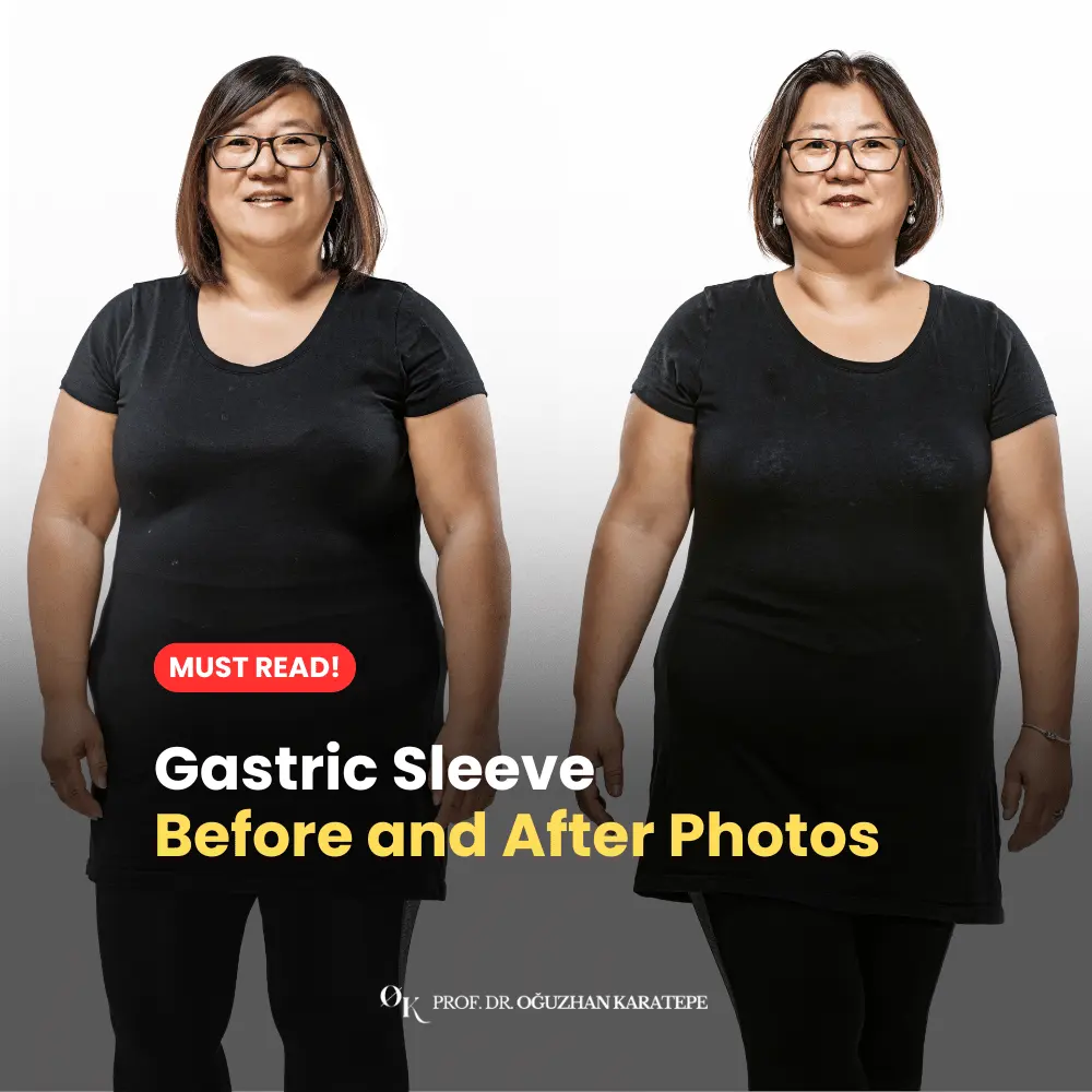 gastric sleeve befor and after photo gallery