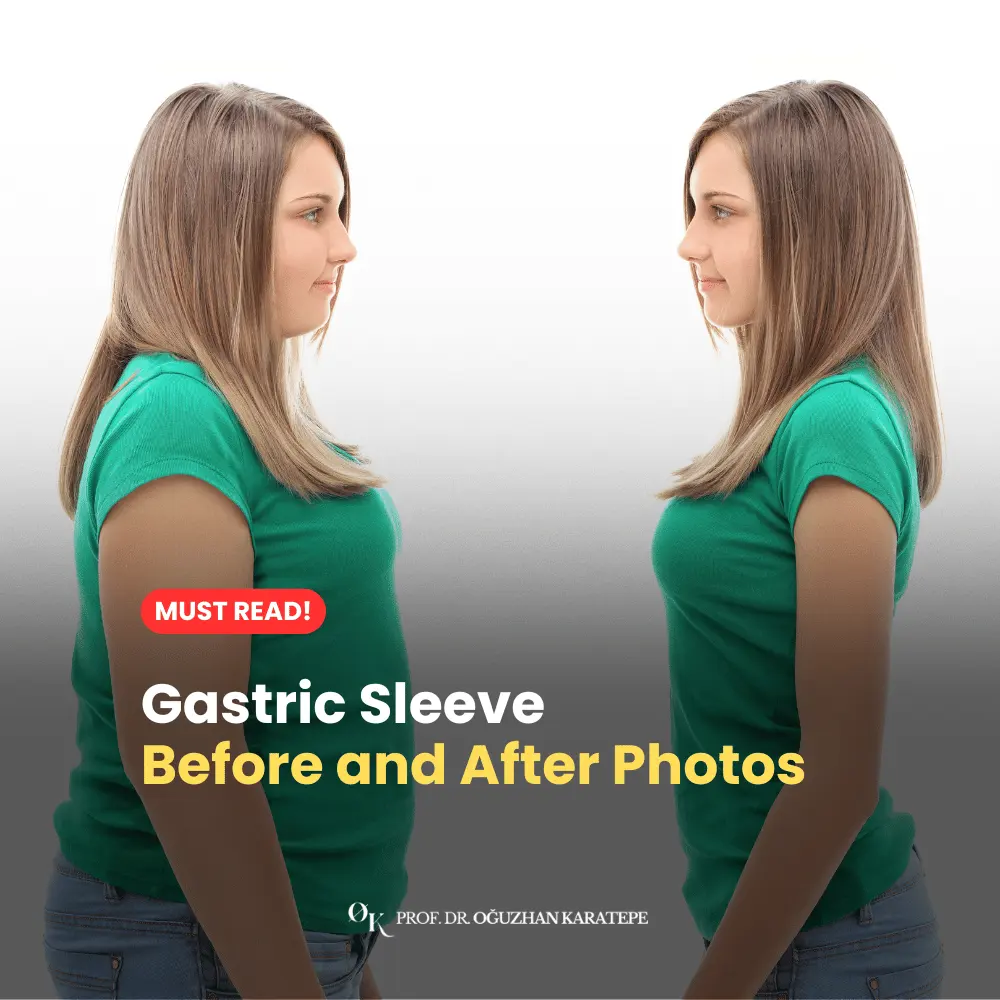 gastric sleeve befor and after photos