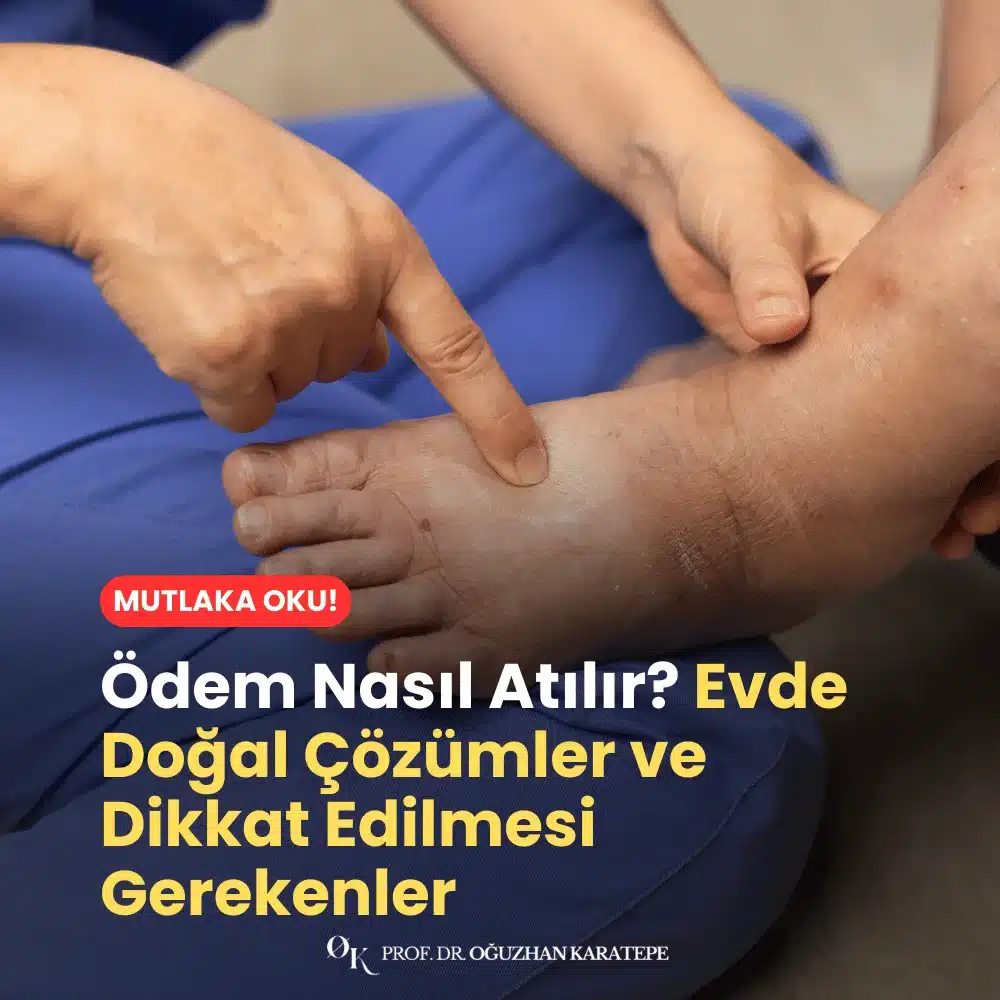 Ödem Nasıl Atılır? Evde Doğal Çözümler ve Dikkat Edilmesi Gerekenler Neler