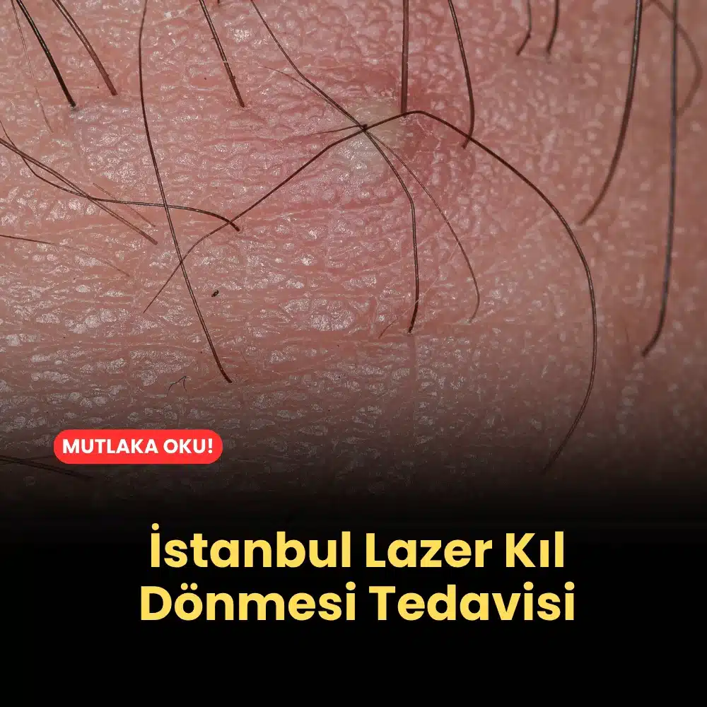 İstanbul Lazer Kıl Dönmesi Tedavisi